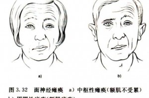 什么叫肌瘫 