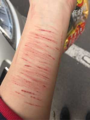 什么程度算自残 