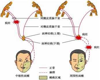 什么叫肌瘫 
